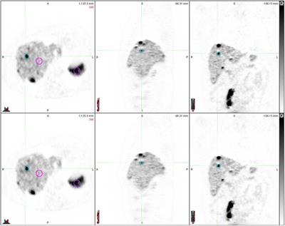 Population-based input function (PBIF) applied to dynamic whole-body 68Ga-DOTATOC-PET/CT acquisition